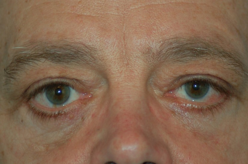 Lower eyelids-after