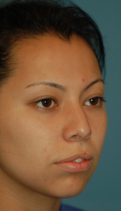 Open cleft rhinoplasty and lip scar revision-before